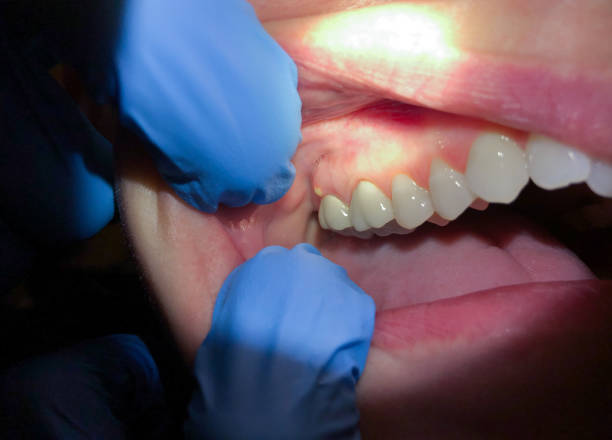 Best Emergency Dentist for Lost Fillings or Crowns in Bedford, IN